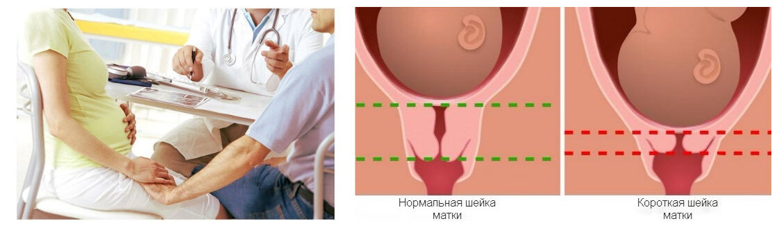 Утрожестан при планировании беременности: инструкция по применению, отзывы, побочные эффекты