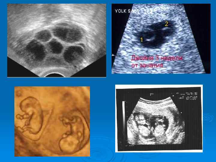 Беременность двойней: рекомендации будущим мамам и основные опасности