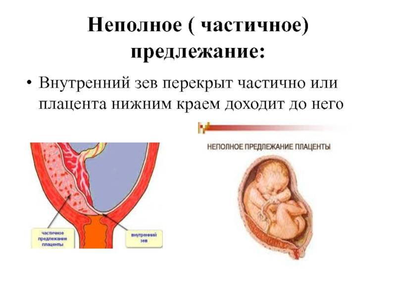 Плацента по задней стенке: что значит краевое предлежание по задней стенке матки, особенности расположения и прогнозы