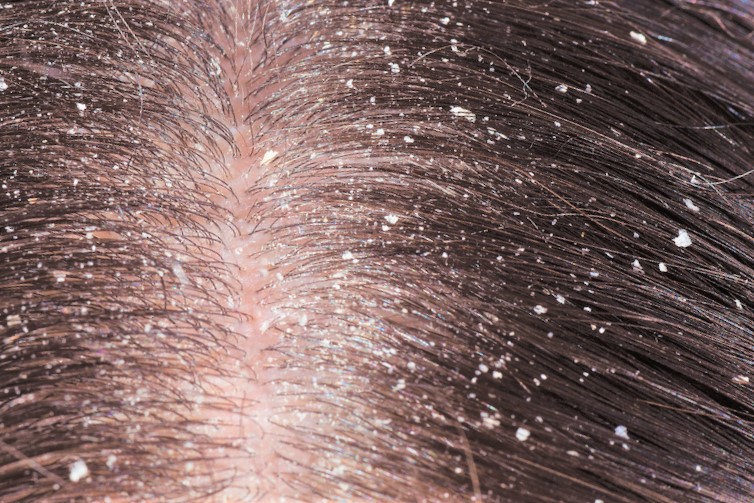 Методы эффективного увлажнения кожи головы и волос