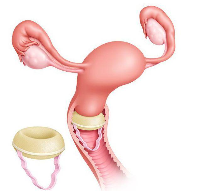 Контрацептивные губки - противозачаточное средство фарматекс и аналоги, инструкция по применению, отзывы
