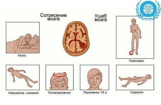 Симптомы и признаки сотрясения головного мозга у грудничка, возможные последствия