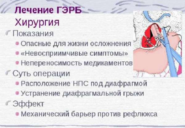 Гастроэзофагеальный рефлюкс у детей: лечение гэрб, симптомы | medboli.ru