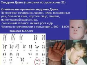 Синдром дауна - трисомия 21 - медико-генетический центр мама папа