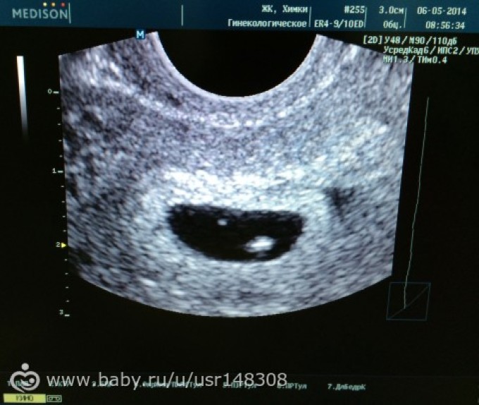 Эмбрион не визуализируется на 6 неделе