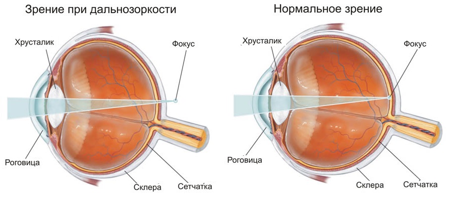 Гиперметропия слабой степени: симптомы, методы лечения - "здоровое око"