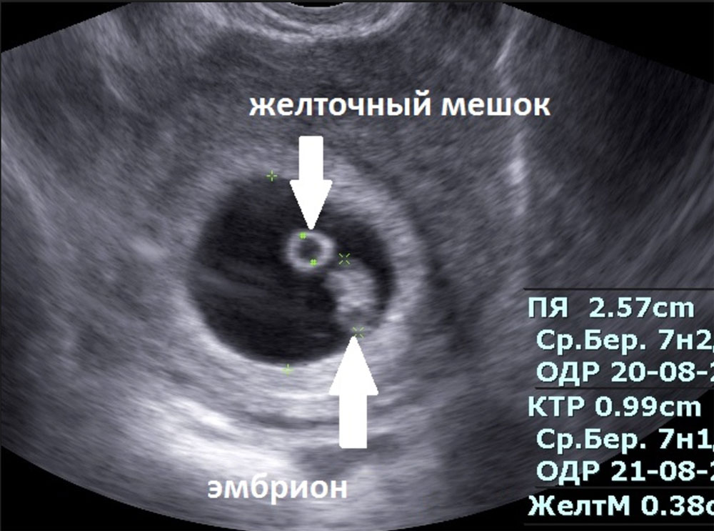 Не визуализируется чётко эмбрион - вопрос гинекологу - 03 онлайн