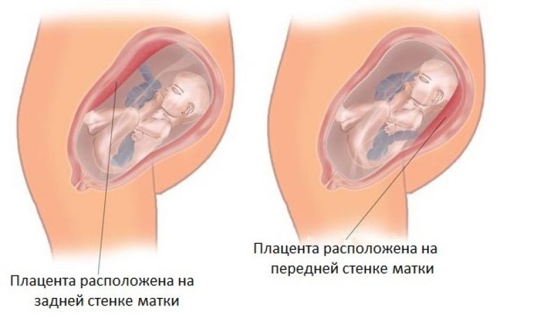 Виды расположения плаценты: по передней, задней и боковой стенке матки, опасность низкой плацентации