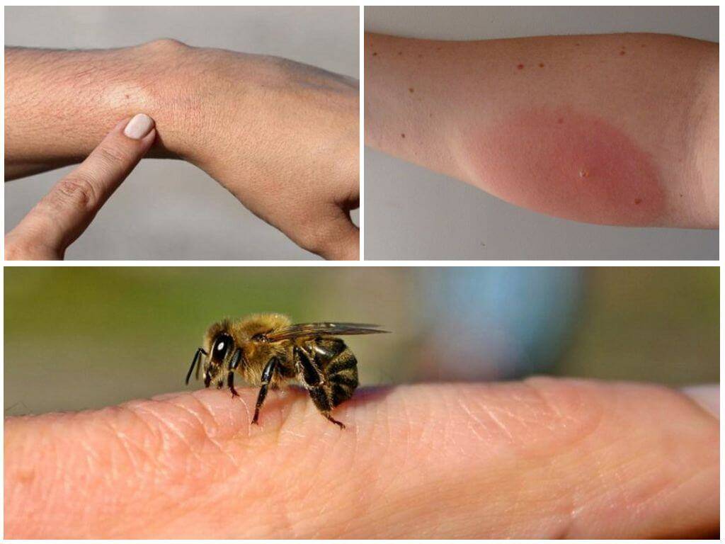 Как распознать и предотвратить анафилактический шок от укуса насекомых - первая помощь