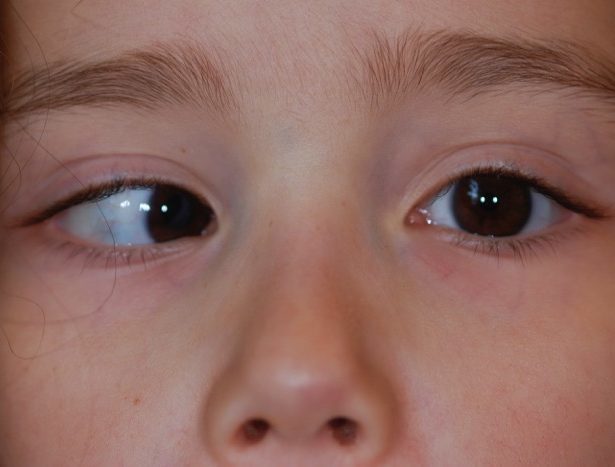 Косоглазие у детей – виды, причины и лечение. как исправить косоглазие у ребенка