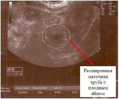 Когда на узи видно плодное яйцо, почему эмбрион не визуализируется на сроке 6–7 недель беременности?