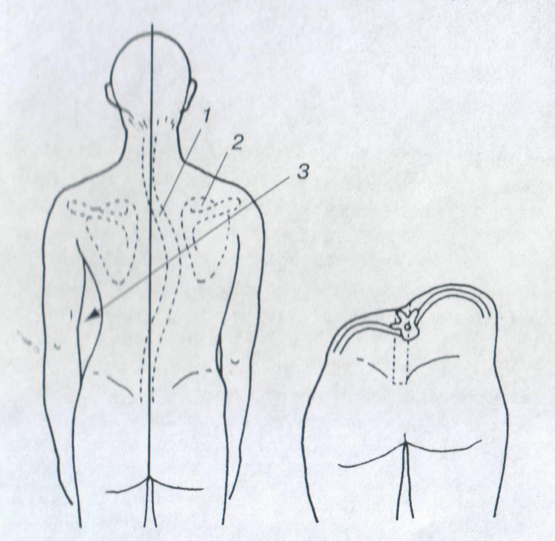 Лечебный массаж спины при сколиозе