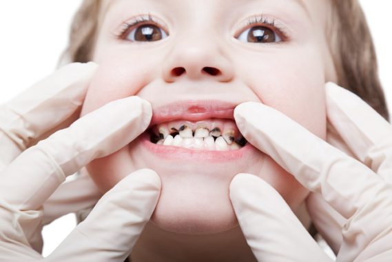 Причины кариеса молочных зубов у детей. лечение кариеса у детей