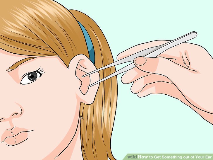 Инородное тело уха: симптомы, что делать, неотложная помощь ребенку и взрослому