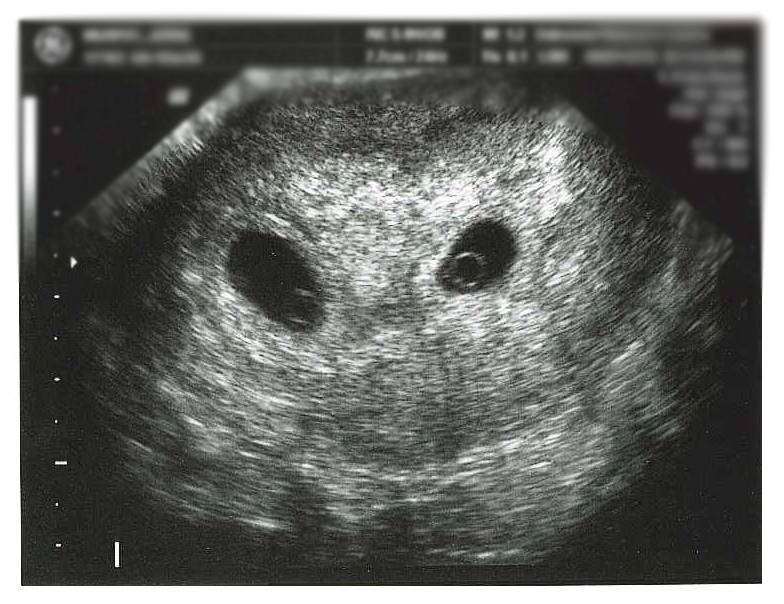 Многоплодная беременность на узи на ранних сроках: на какой неделе можно определить и когда точно видно наличие нескольких эмбрионов, а также фото исследования