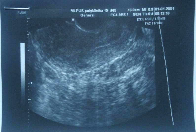 Может ли УЗИ показать наличие беременности на 1 неделе, что можно увидеть на фото, информативен ли экспресс-тест?