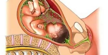 Трихомониаз при беременности: как распознать и чем лечить?