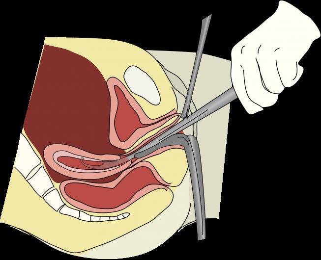 Катетер для стимуляции родов при доношенной беременности: как применяют и устанавливают катетер фолея в шейку матки, противопоказания, осложнения после процедуры