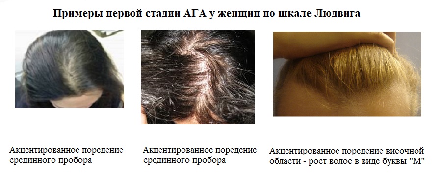 Выпадение волос у детей: причины и лечение у ребенка
