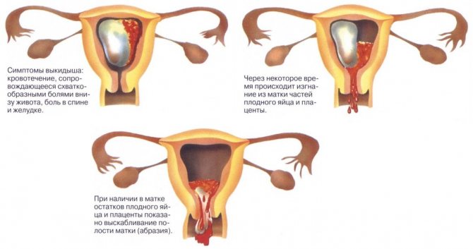 Как определить зачатие: могут ли быть месячные при беременности