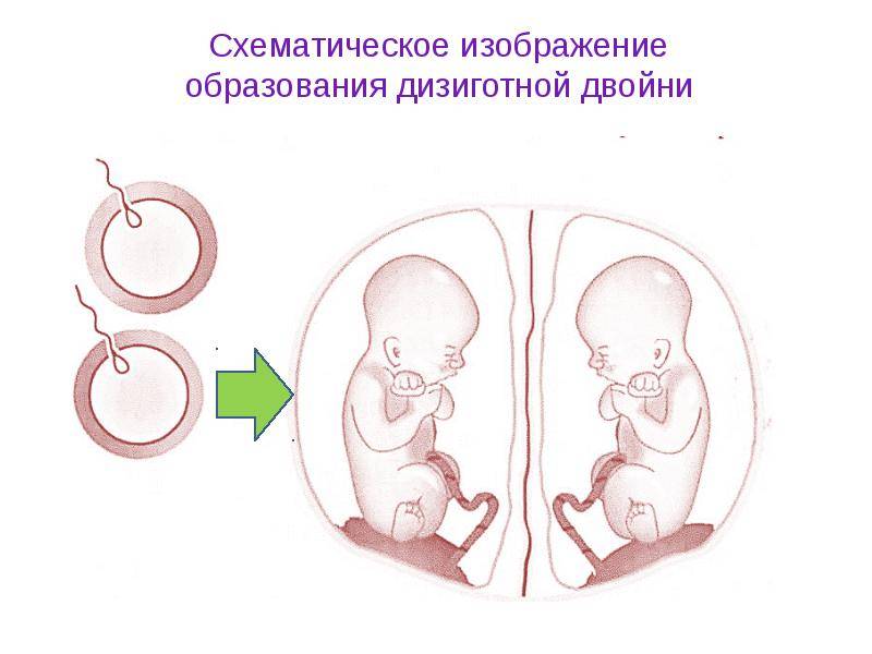 Показания к редукции эмбриона при многоплодной беременности и двойне, осложнения, вероятность саморедукции плода