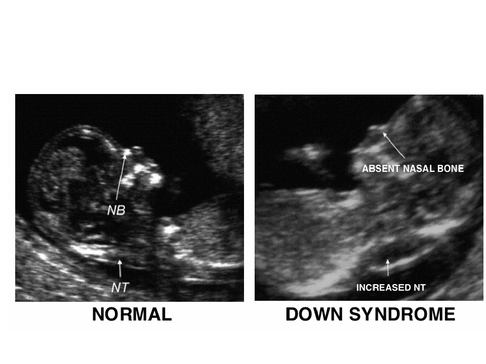 Роды на 12 неделе. УЗИ С синдромом Дауна 1 триместр. УЗИ 1 триместр беременности синдром Дауна. УЗИ на 12 недели беременности с синдромом Дауна. УЗИ скрининг 1 триместра синдром Дауна.