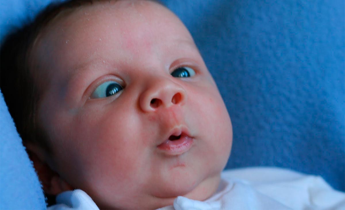 Косоглазие у новорождённых: почему возникает и когда проходит