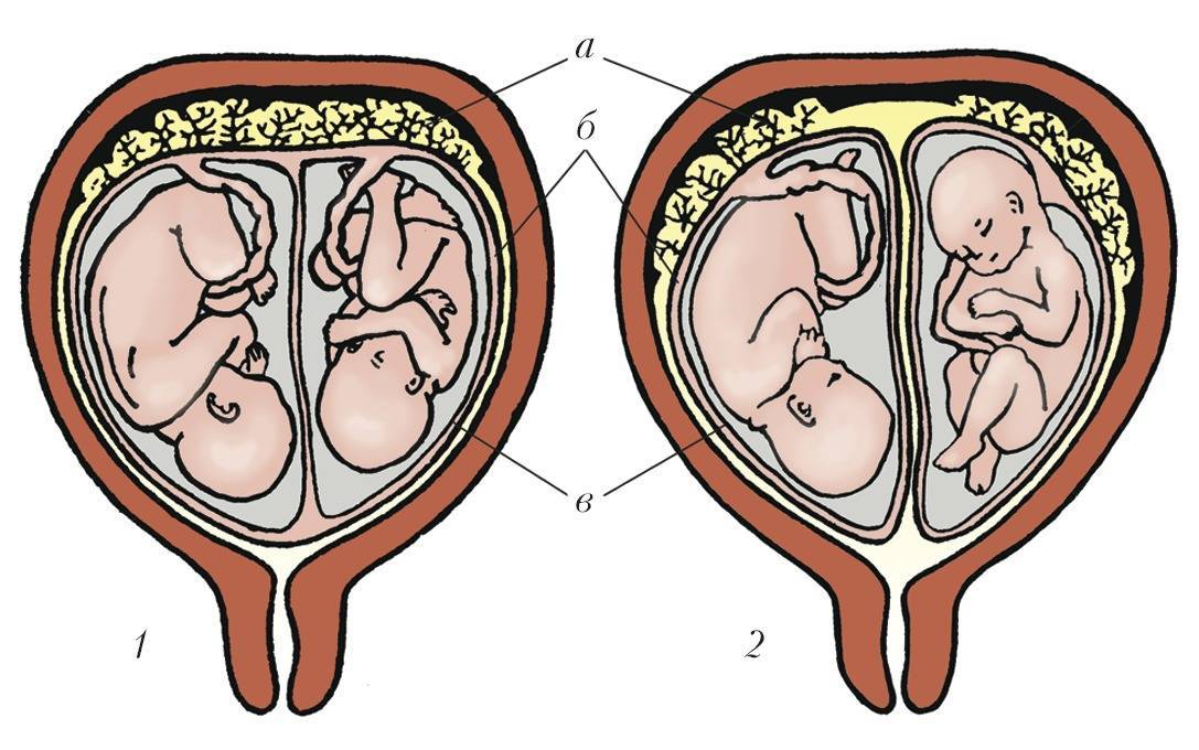 Редукция эмбрионов при двойне, многоплодной беременности