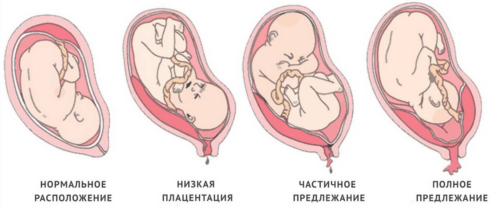 Низкое расположение в матке плода при беременности: в чем причина, что делать и может ли ребенок подняться?