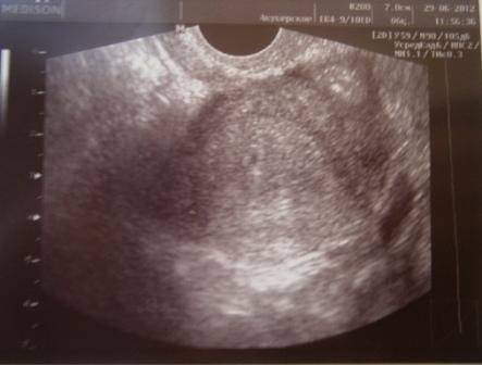 Узи для определения беременности: на каком сроке можно делать и увидеть эмбрион в матке, на какой день задержки, когда после зачатия, как называется, подготовка, цена, погрешность