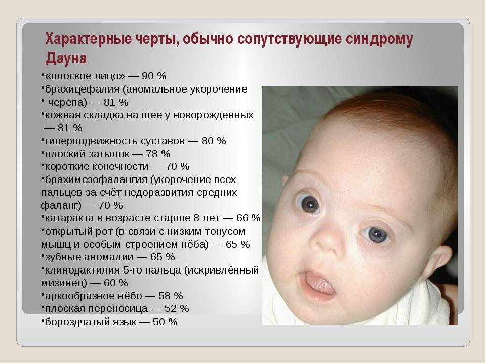 Признаки синдрома дауна малыша: в утробе и после рождения  — журнал "рутвет"