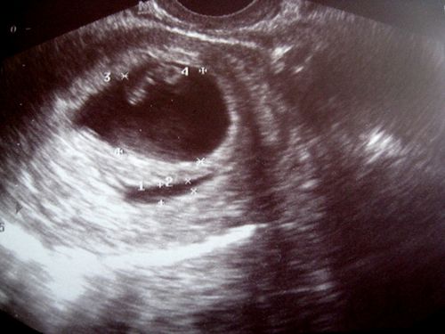 Гематома 6 недель. Краевая отслойка хориона. Отслойка хориона на ранних сроках беременности УЗИ. Отслойка плаценты хориона.
