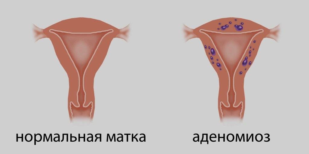 Беременность при гиперплазии эндометрия - можно ли забеременеть?