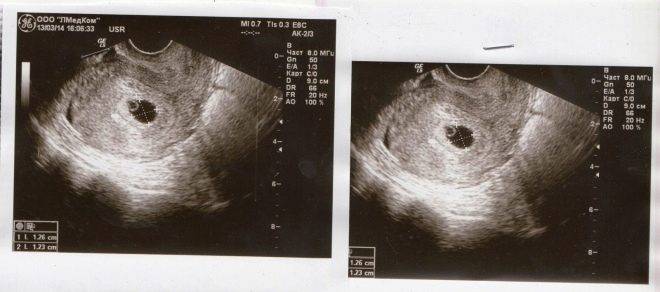 На какой неделе видно эмбрион на узи? плодное яйцо эмбриона на узи