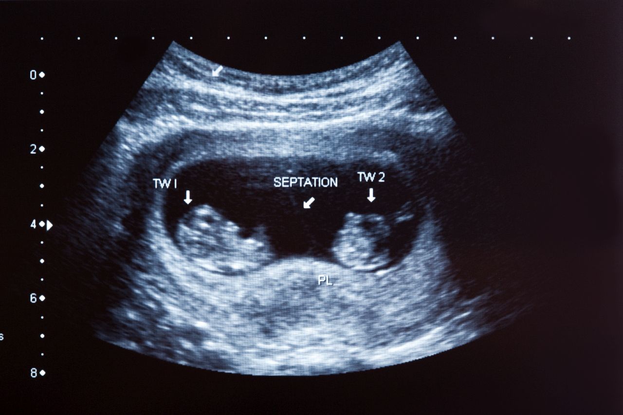 Признаки двойни на ранних сроках беременности: как определить женщине