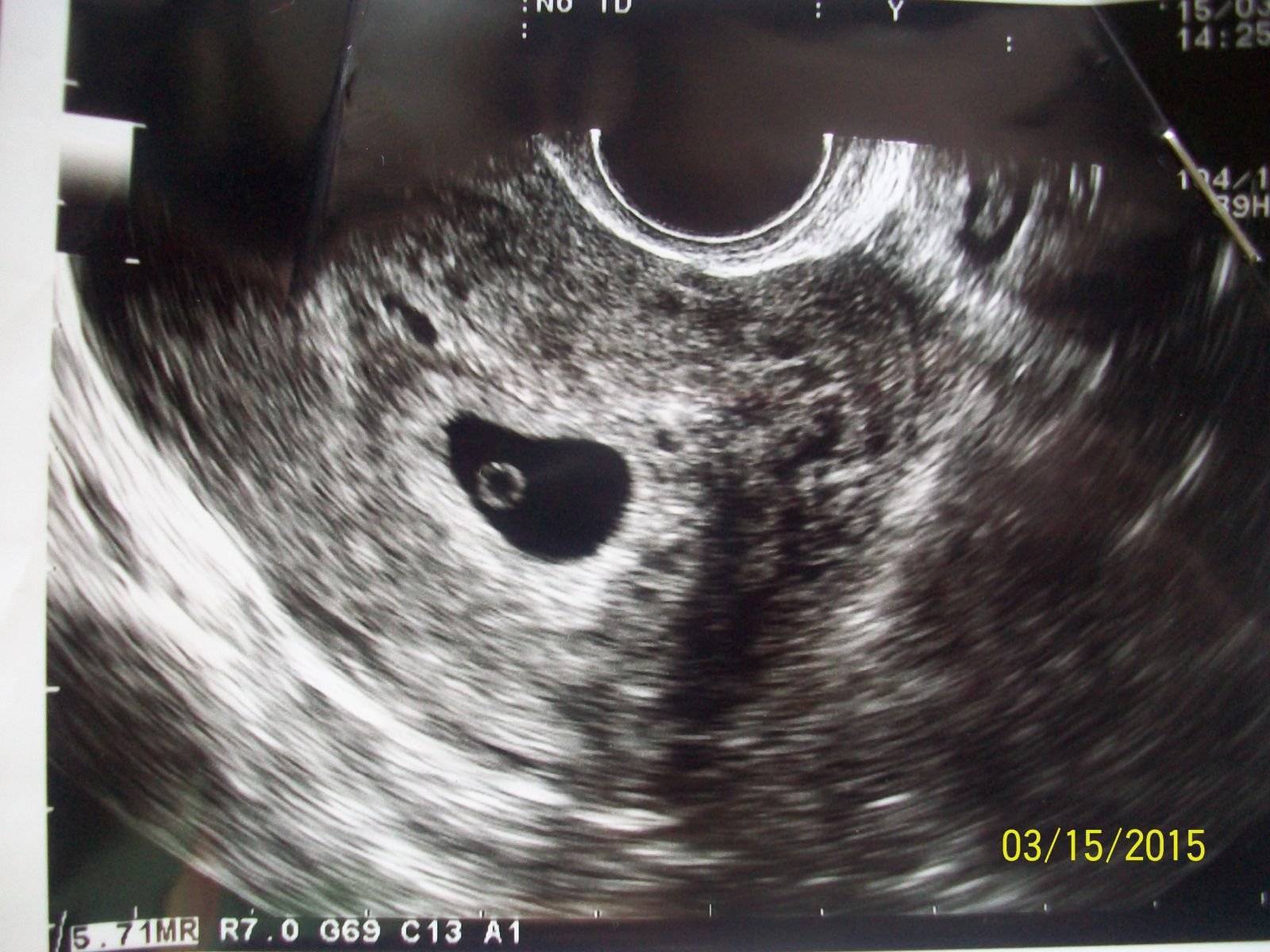Эмбрион не визуализируется что это значит - все о беременности
