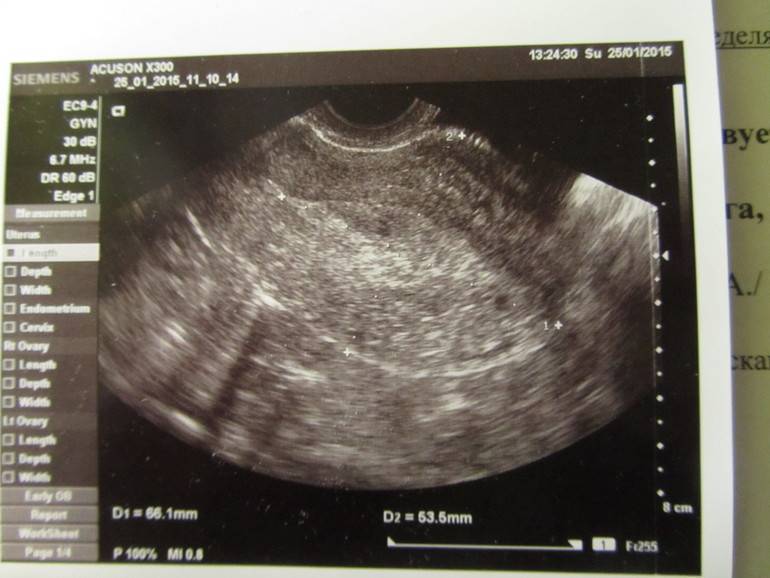 Узи на 5 неделе беременности (23 фото): размер плода, что видно и что покажет, можно ли делать узи, особенности при двойне
