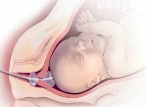 Катетер при родах для раскрытия шейки матки - информация, которая удивляет