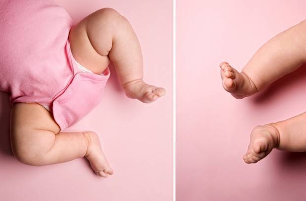 Дисплазия тазобедренного сустава у новорожденных и грудничков