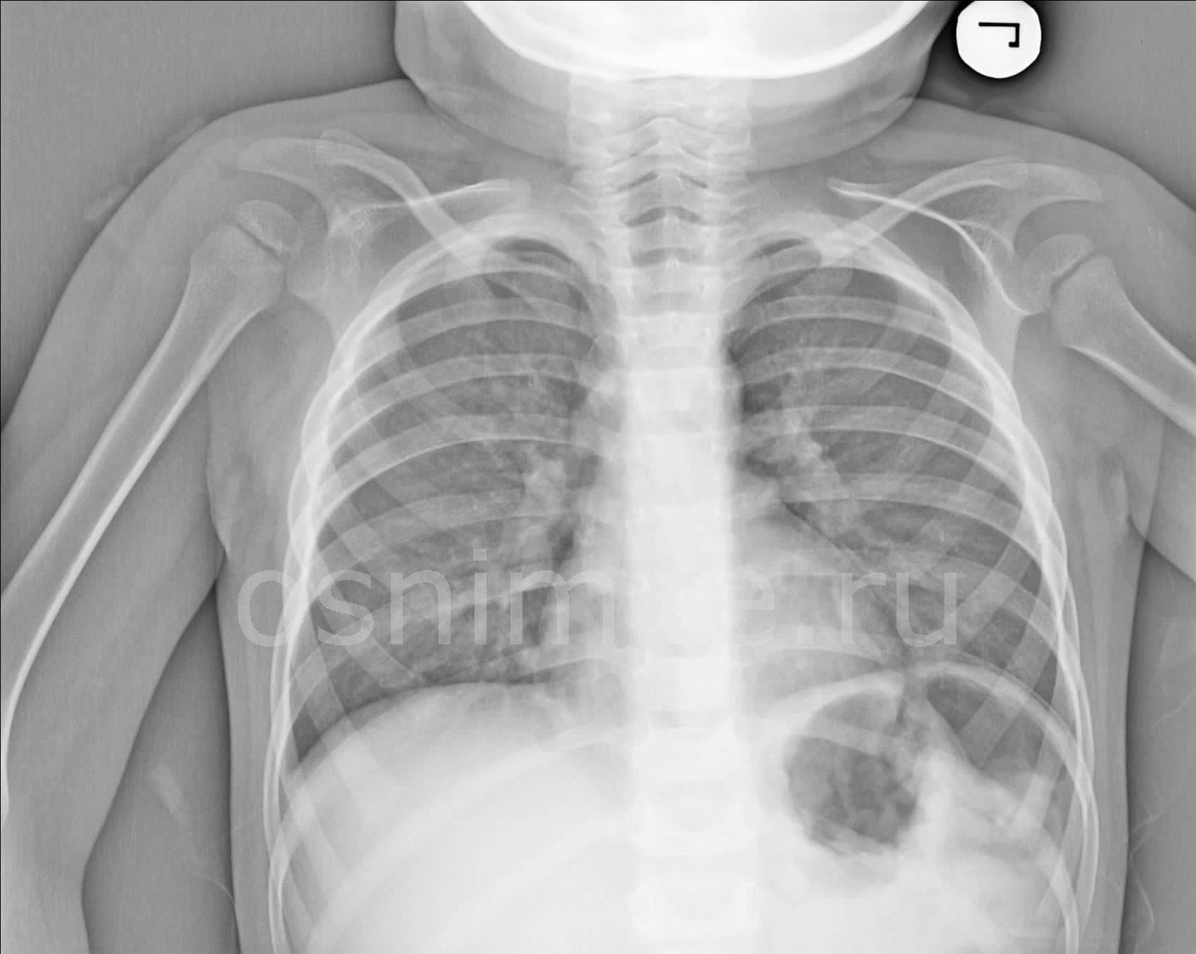Как часто ребенку можно делать рентген грудной клетки, легких, животика или головы – опасна ли процедура?