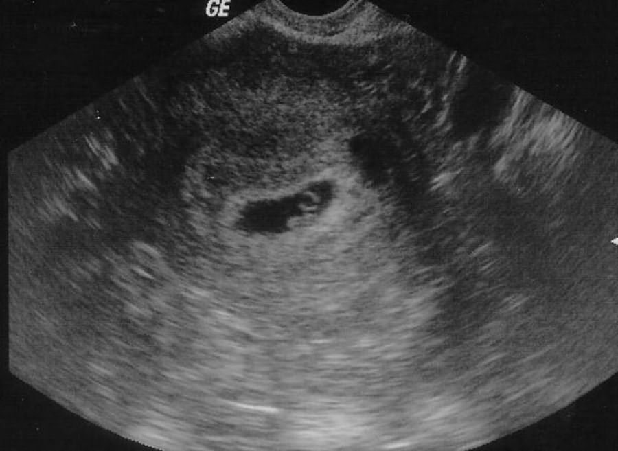 Узи на 8 неделе беременности (20 фото): размер плода и нормы малого таза, что показывает узи на 8 акушерской неделе, особенности у двойни