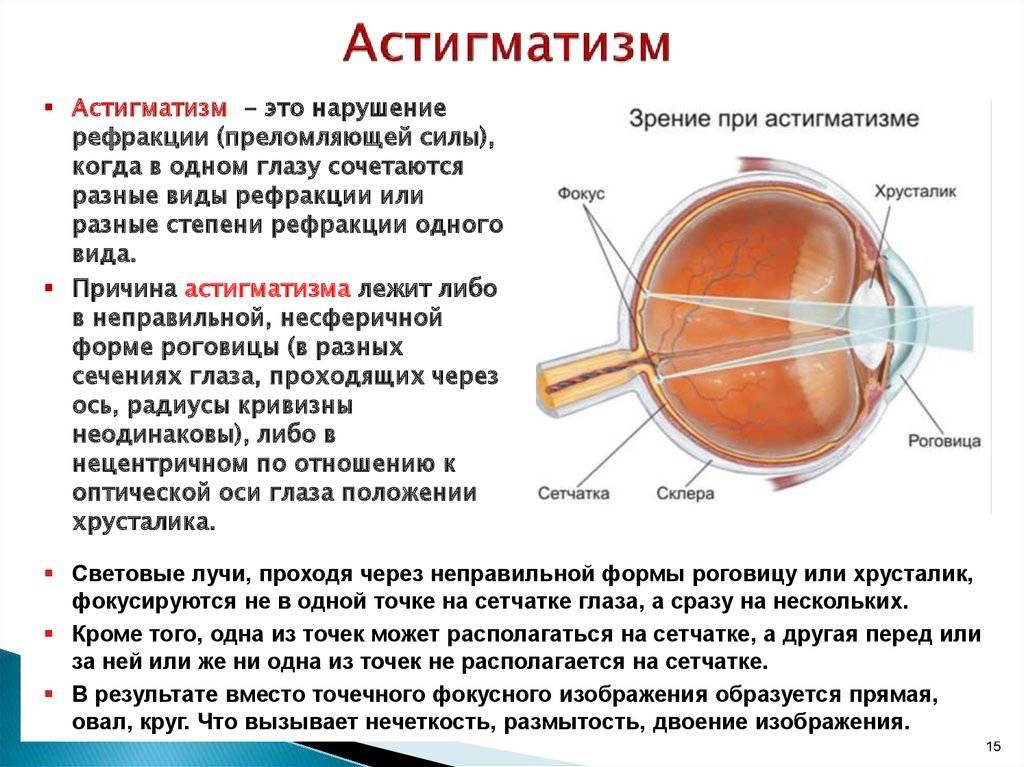 Профилактика близорукости (миопии) у детей и взрослых: методы, гигиена зрения, гимнастика, витамины
