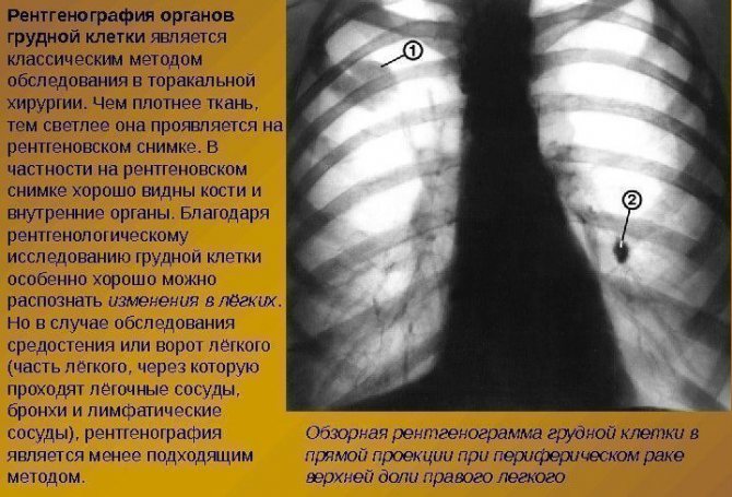 Как часто можно делать рентген легких без вреда
