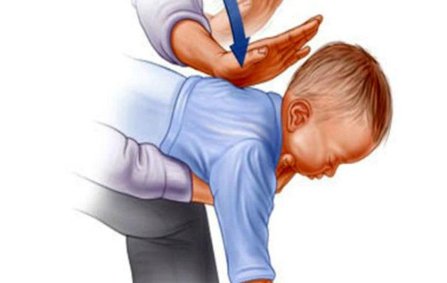 Что делать, если ребенок подавился и задыхается, первая помощь грудничку, малышу старше года