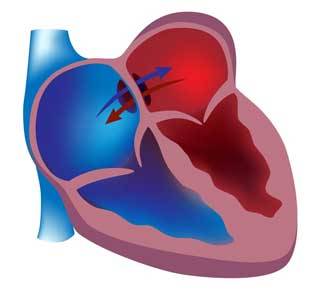 Открытое овальное окно в сердце: причины, симптомы, лечение и прогнозы