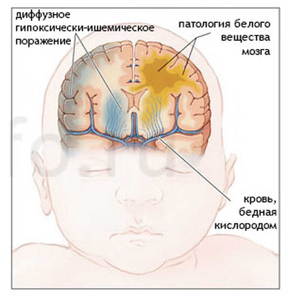 Водянка головного мозга у новорожденного фото