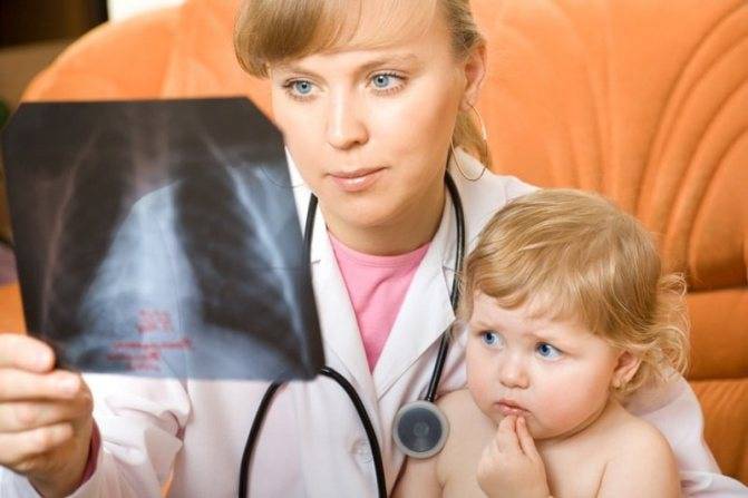 Пневмония у ребенка: симптомы и виды
