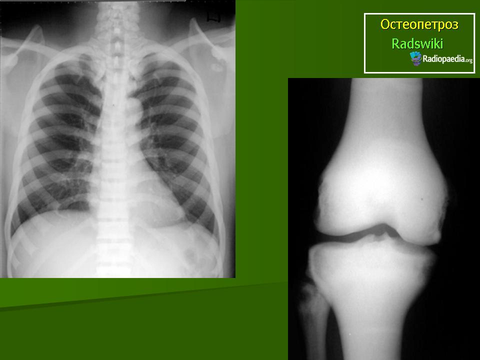 Остеопетроз у детей: причины, симптомы и лечение мраморной болезни с фото