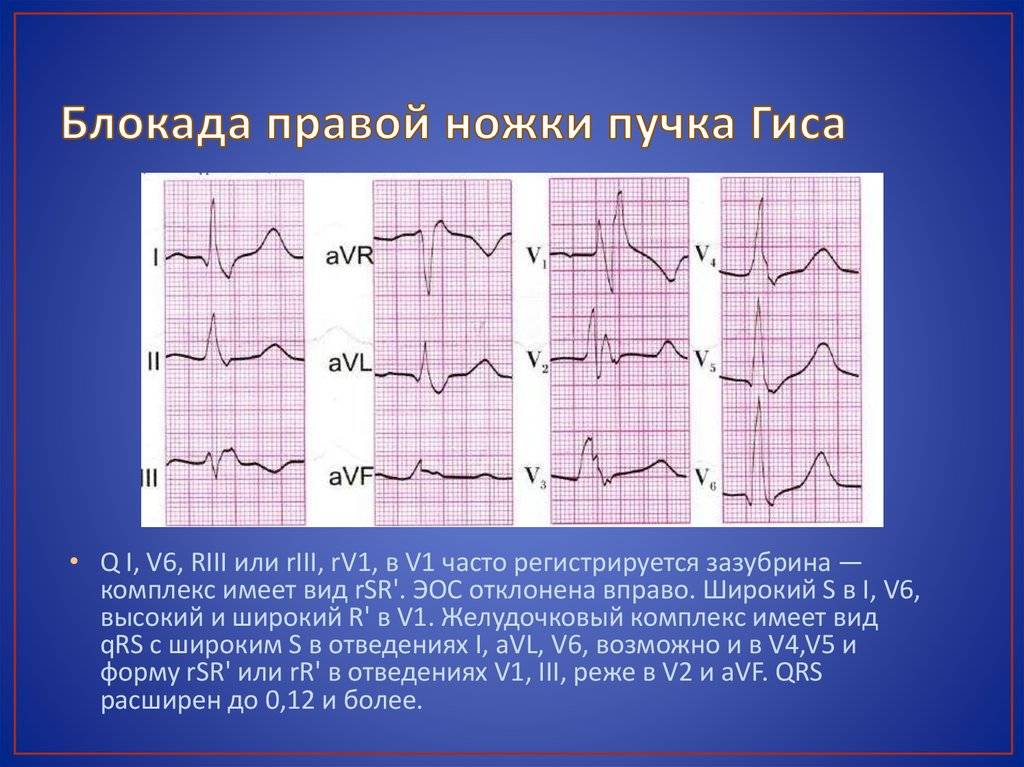 Блокада правой ножки пучка гиса на экг фото