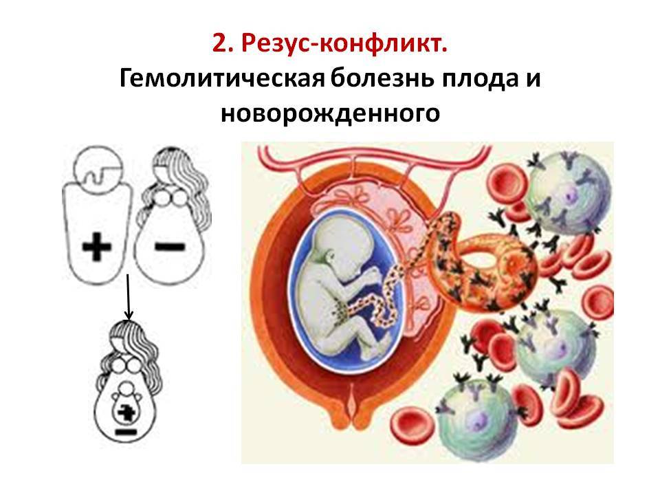 Гемолитическая болезнь новорожденных: этиология, причины, лечение  - krasgmu.net